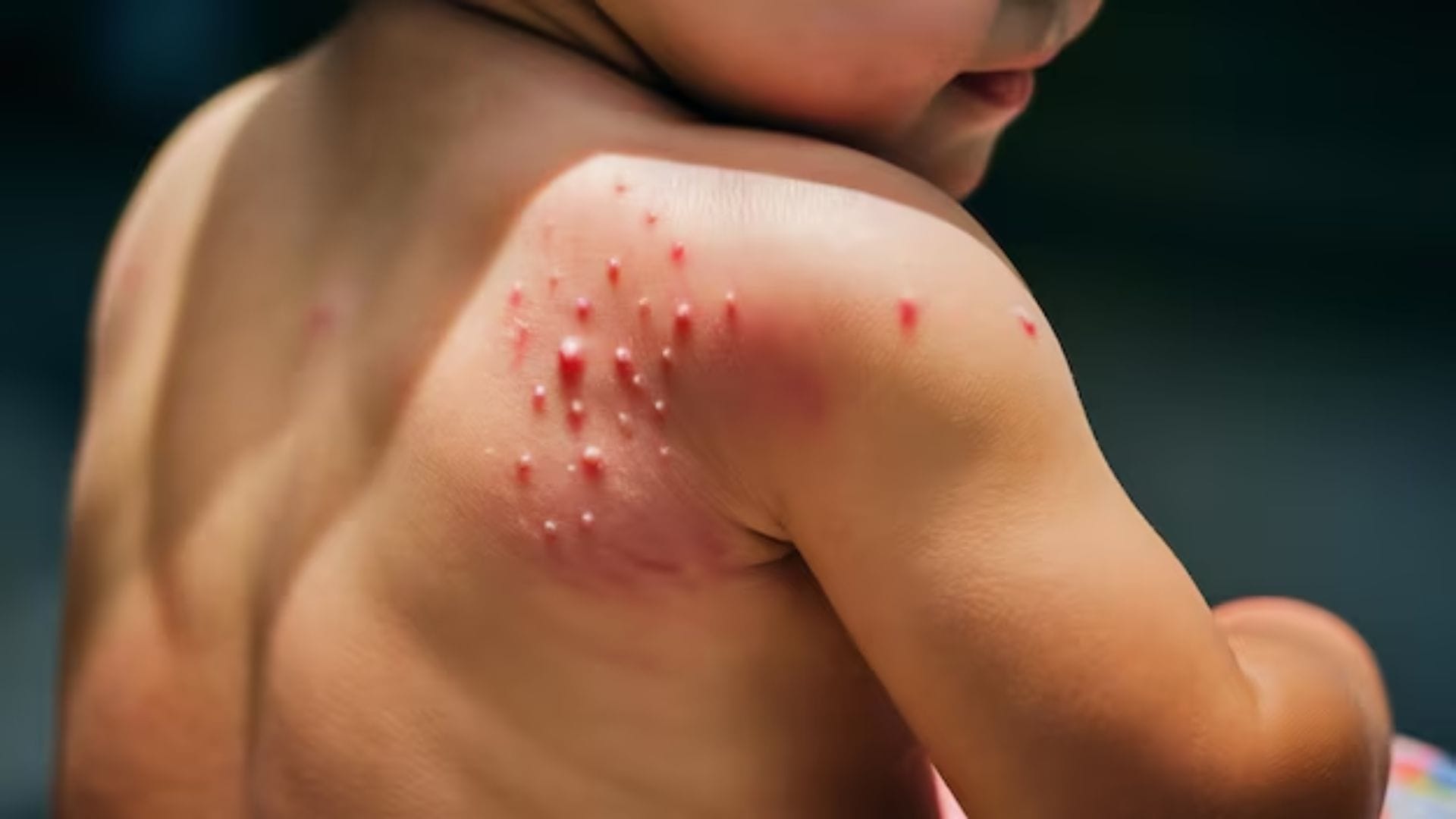 চন্দনের শীতলকারক গুণ ঘামাচির মোক্ষম দাওয়াই। চন্দন ও গোলাপ জলের পেস্ট ত্বকের তাপমাত্রা কমিয়ে আরাম দেয় এবং ঘামাচি সারিয়ে তোলে।