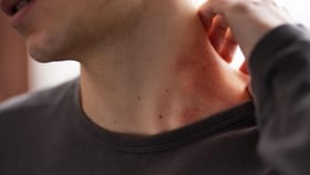 চরম গরমে শরীর জুড়ে ঘামাচি? জাস্ট এই নিয়ম মানলেই সব হবে গায়েব