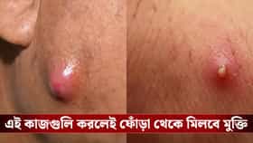 প্রাণ একেবারে ওষ্ঠাগত! এই কাজগুলি করলে নিমেষে উধাও হবে ফোঁড়ার ব্যথা