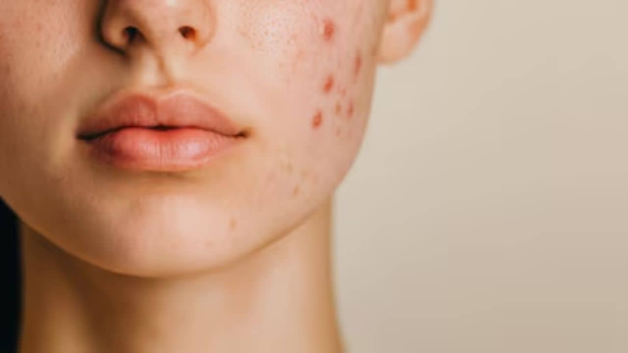 Pimple Removal: জাস্ট এক ফোঁটা ব্রণ উপর লাগিয়ে দিলেই রাতারাতি গায়েব!