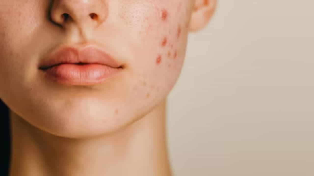 Pimple Removal: জাস্ট এক ফোঁটা ব্রণ উপর লাগিয়ে দিলেই রাতারাতি গায়েব! Pimple Removal: জাস্ট এক ফোঁটা ব্রণ উপর লাগিয়ে দিলেই রাতারাতি গায়েব!