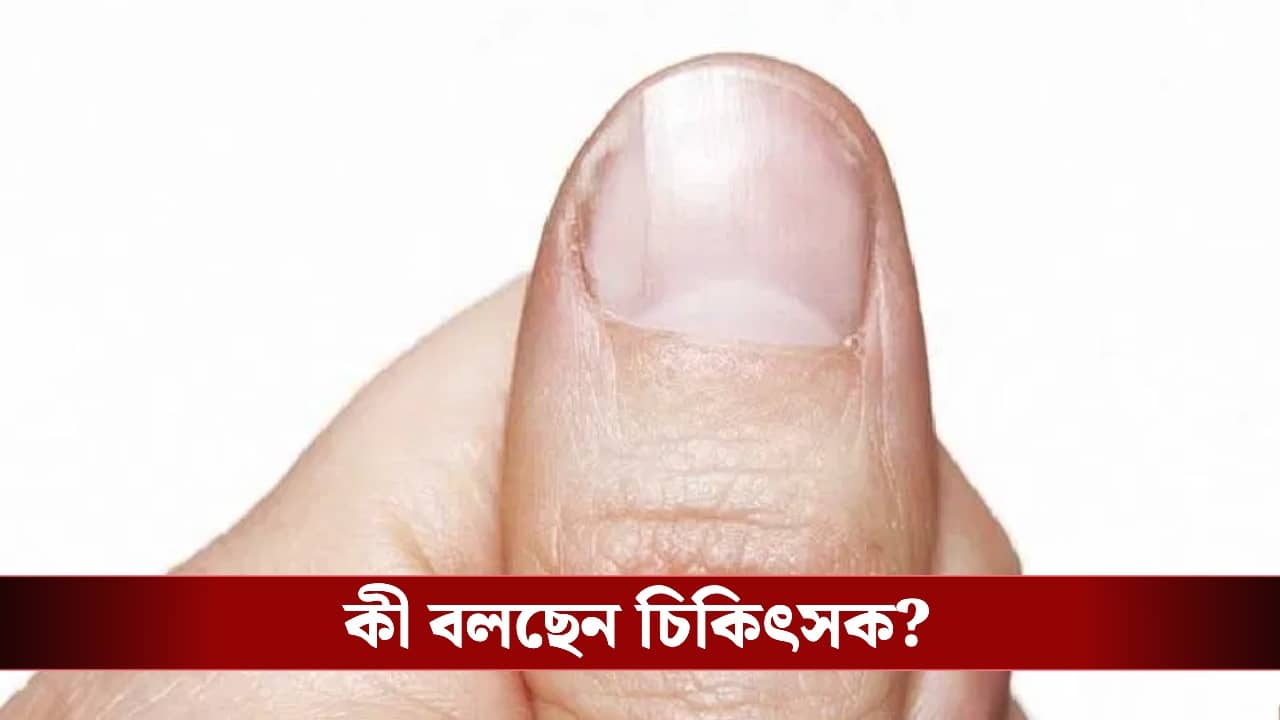 Nail half moon disease warning: নখের সাদা চাঁদ কি কোনও বড় অসুখের ইঙ্গিত? এড়িয়ে যাওয়ার ভুল করবেন না, জানালেন চিকিৎসক!