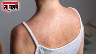Measles Symptoms: হামের প্রকোপ নিয়ে চিন্তা বাড়ছে আমেরিকার, কারণ খুঁজতে গিয়েই যা সামনে এল…