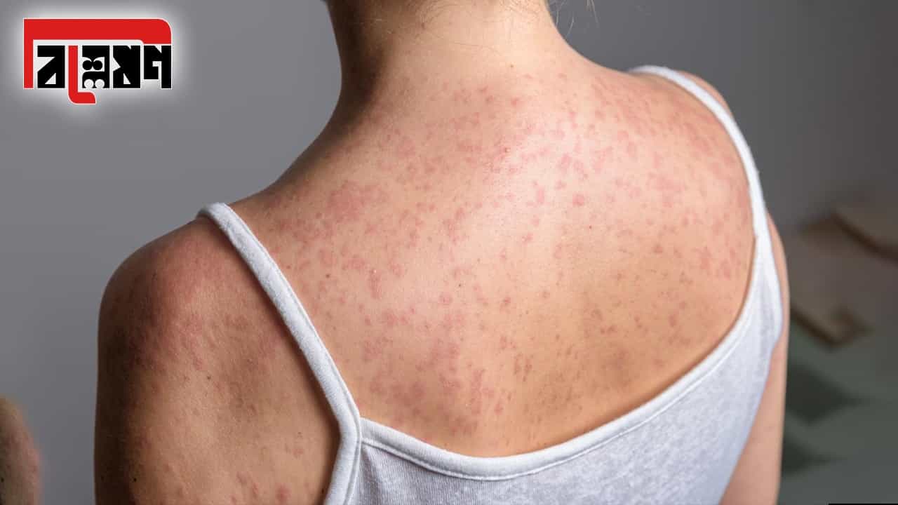 Measles Symptoms: হামের প্রকোপ নিয়ে চিন্তা বাড়ছে আমেরিকার, কারণ খুঁজতে গিয়েই যা সামনে এল... Measles Symptoms: হামের প্রকোপ নিয়ে চিন্তা বাড়ছে আমেরিকার, কারণ খুঁজতে গিয়েই যা সামনে এল...